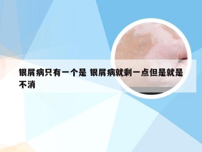 银屑病只有一个是 银屑病就剩一点但是就是不消