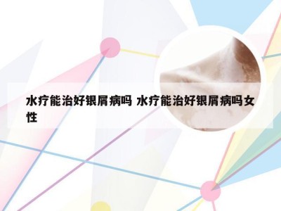 水疗能治好银屑病吗 水疗能治好银屑病吗女性