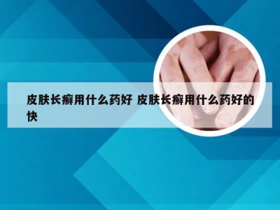 皮肤长癣用什么药好 皮肤长癣用什么药好的快