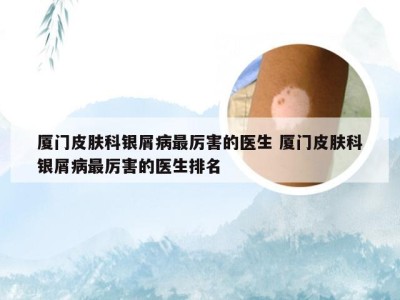 厦门皮肤科银屑病最厉害的医生 厦门皮肤科银屑病最厉害的医生排名
