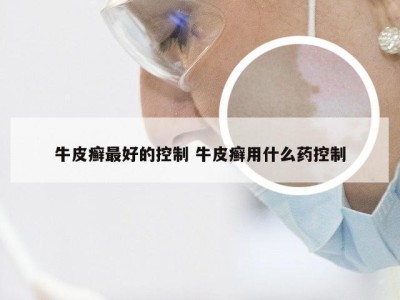 牛皮癣最好的控制 牛皮癣用什么药控制