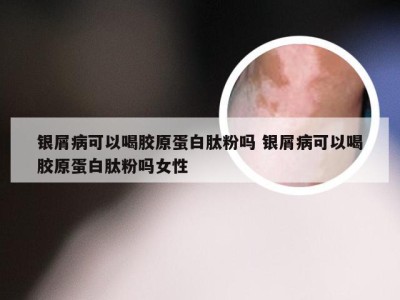 银屑病可以喝胶原蛋白肽粉吗 银屑病可以喝胶原蛋白肽粉吗女性