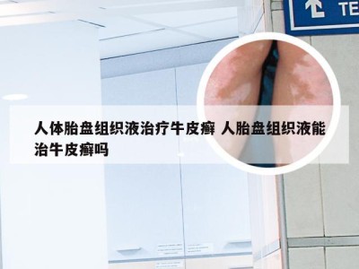 人体胎盘组织液治疗牛皮癣 人胎盘组织液能治牛皮癣吗