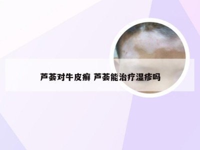 芦荟对牛皮癣 芦荟能治疗湿疹吗