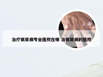治疗银屑病专业医院在哪 治银屑病的医院