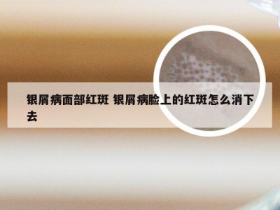 银屑病面部红斑 银屑病脸上的红斑怎么消下去