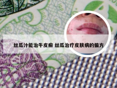 丝瓜汁能治牛皮癣 丝瓜治疗皮肤病的偏方