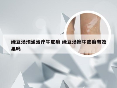 绿豆汤泡澡治疗牛皮癣 绿豆汤擦牛皮癣有效果吗