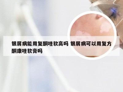 银屑病能用复酮唑软高吗 银屑病可以用复方酮康唑软膏吗