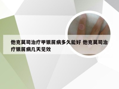 他克莫司治疗甲银屑病多久能好 他克莫司治疗银屑病几天见效
