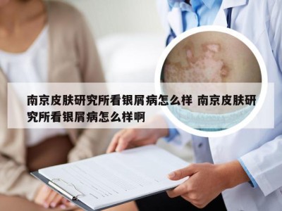 南京皮肤研究所看银屑病怎么样 南京皮肤研究所看银屑病怎么样啊