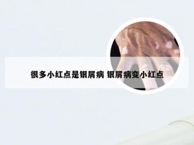 很多小红点是银屑病 银屑病变小红点