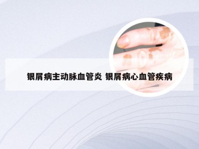 银屑病主动脉血管炎 银屑病心血管疾病