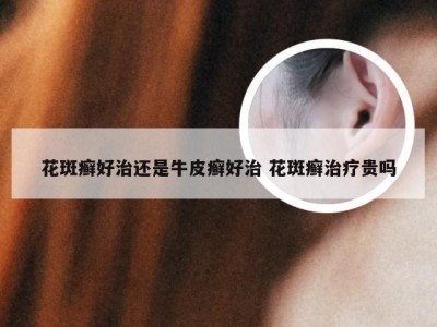 花斑癣好治还是牛皮癣好治 花斑癣治疗贵吗
