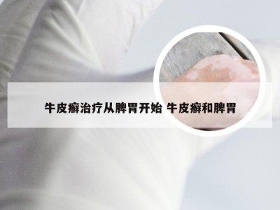 牛皮癣治疗从脾胃开始 牛皮癣和脾胃