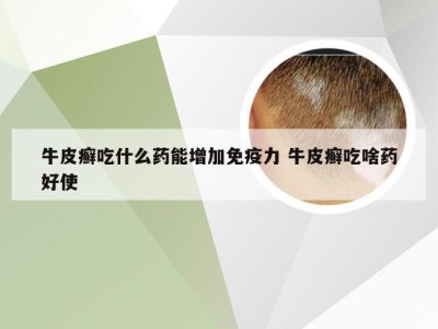 牛皮癣吃什么药能增加免疫力 牛皮癣吃啥药好使