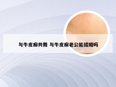 与牛皮癣共舞 与牛皮癣老公能结婚吗