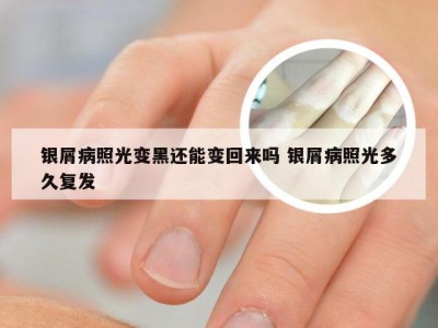 银屑病照光变黑还能变回来吗 银屑病照光多久复发