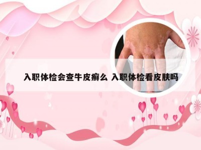 入职体检会查牛皮癣么 入职体检看皮肤吗