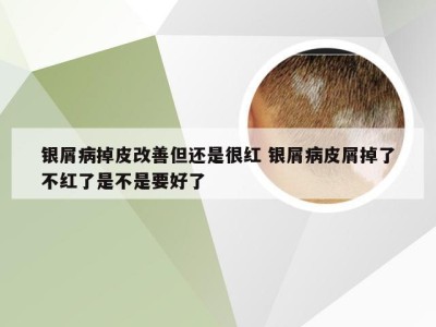 银屑病掉皮改善但还是很红 银屑病皮屑掉了不红了是不是要好了