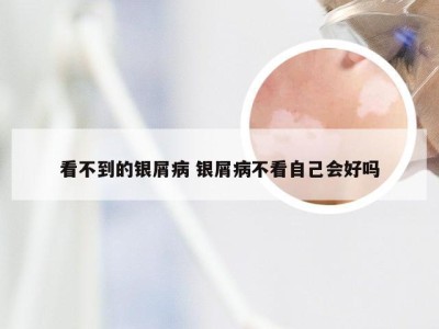 看不到的银屑病 银屑病不看自己会好吗