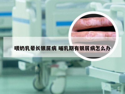 喂奶乳晕长银屑病 哺乳期有银屑病怎么办