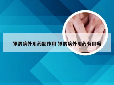 银屑病外用药副作用 银屑病外用药有用吗