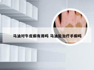 马油对牛皮癣有用吗 马油能治疗手癣吗