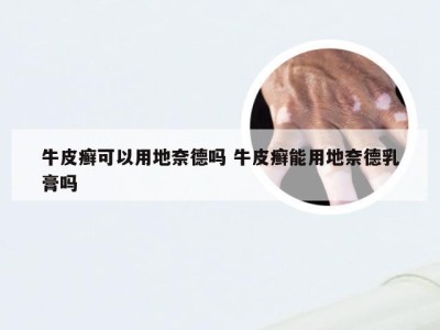 牛皮癣可以用地奈德吗 牛皮癣能用地奈德乳膏吗