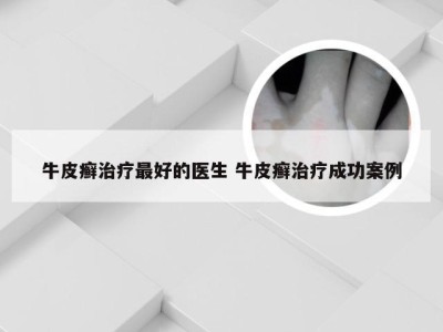 牛皮癣治疗最好的医生 牛皮癣治疗成功案例