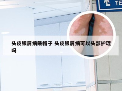头皮银屑病戴帽子 头皮银屑病可以头部护理吗