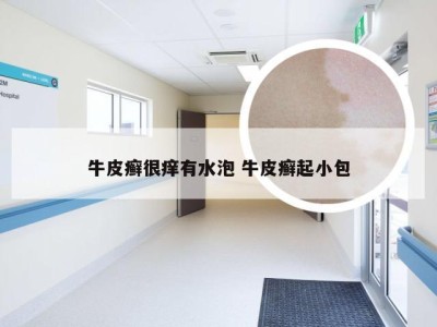 牛皮癣很痒有水泡 牛皮癣起小包