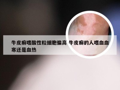牛皮癣嗜酸性粒细胞偏高 牛皮癣的人嗜血血寒还是血热