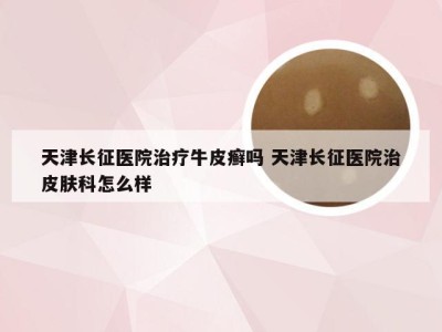 天津长征医院治疗牛皮癣吗 天津长征医院治皮肤科怎么样