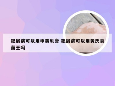 银屑病可以用申黄乳膏 银屑病可以用黄氏真菌王吗