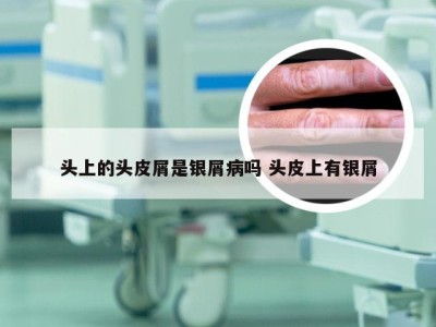 头上的头皮屑是银屑病吗 头皮上有银屑