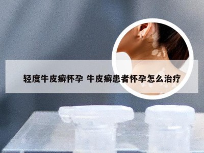 轻度牛皮癣怀孕 牛皮癣患者怀孕怎么治疗
