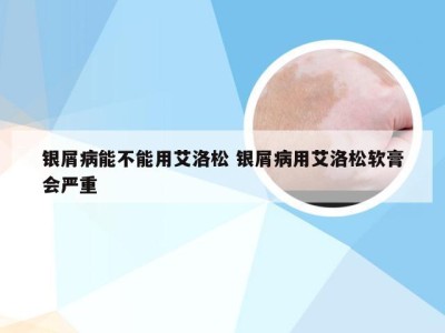 银屑病能不能用艾洛松 银屑病用艾洛松软膏会严重
