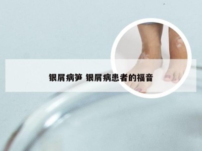 银屑病笋 银屑病患者的福音