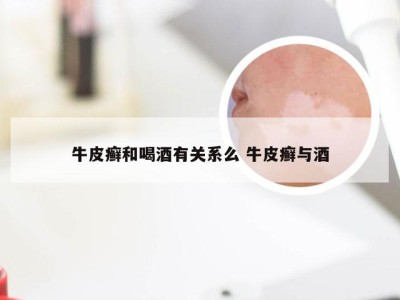 牛皮癣和喝酒有关系么 牛皮癣与酒