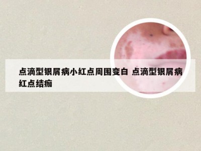 点滴型银屑病小红点周围变白 点滴型银屑病红点结痂