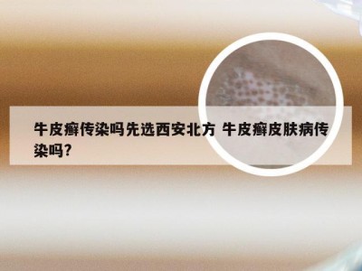 牛皮癣传染吗先选西安北方 牛皮癣皮肤病传染吗?