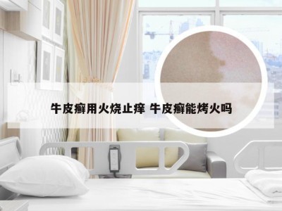 牛皮癣用火烧止痒 牛皮癣能烤火吗