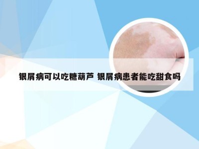银屑病可以吃糖葫芦 银屑病患者能吃甜食吗