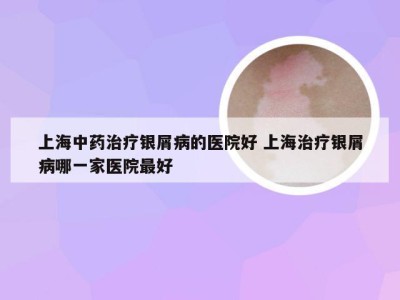 上海中药治疗银屑病的医院好 上海治疗银屑病哪一家医院最好