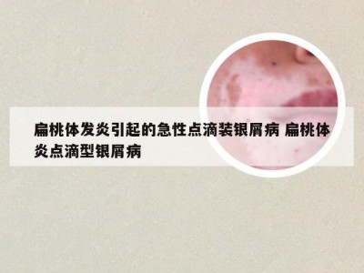 扁桃体发炎引起的急性点滴装银屑病 扁桃体炎点滴型银屑病