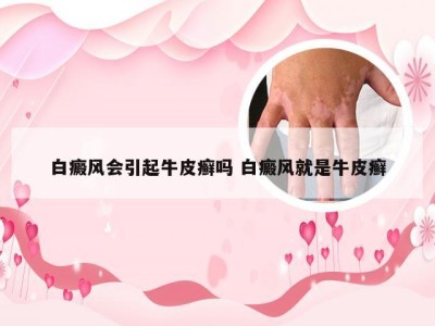 白癜风会引起牛皮癣吗 白癜风就是牛皮癣