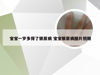 宝宝一岁多得了银屑病 宝宝银屑病图片初期