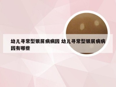 幼儿寻常型银屑病病因 幼儿寻常型银屑病病因有哪些