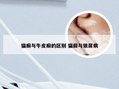 猫癣与牛皮癣的区别 猫藓与银屑病